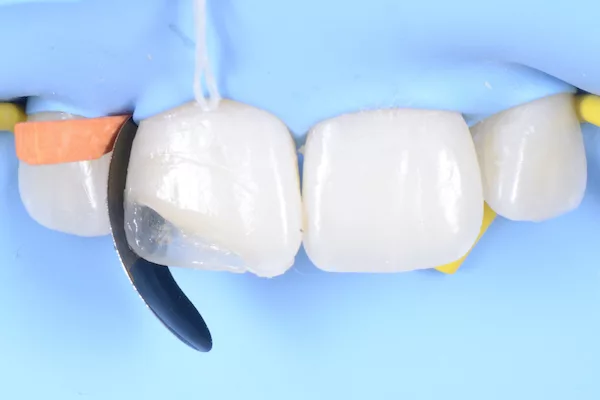formation odontologie restauratrice techniques directes 10