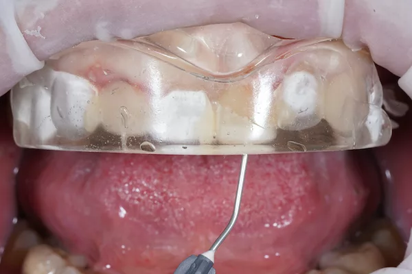 formation odontologie restauratrice techniques directes 11